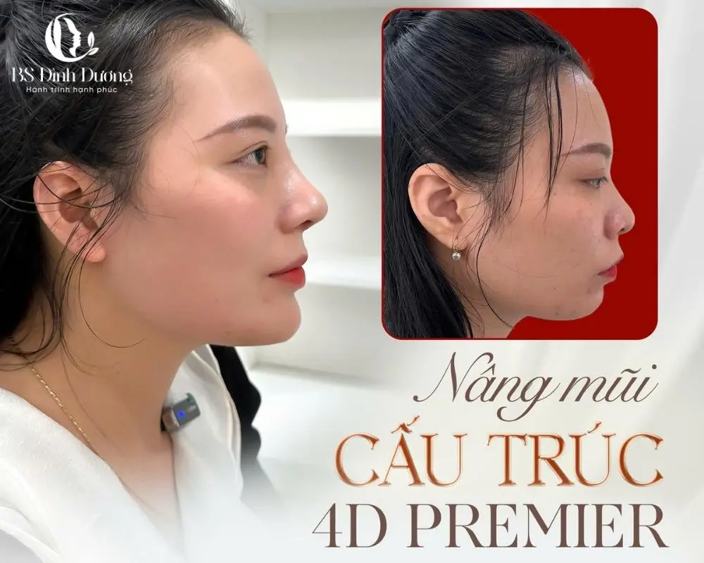 Nâng mũi 4D Premier - công nghệ độc quyền tại thẩm mỹ viện bác sĩ Đình Dương