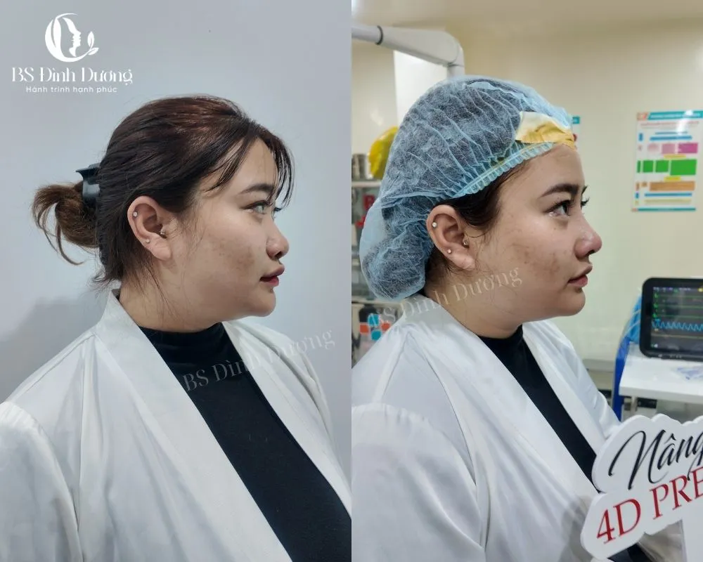 Thu gọn cánh mũi kết hợp nâng mũi - giải pháp cho dáng mũi hoàn hảo
