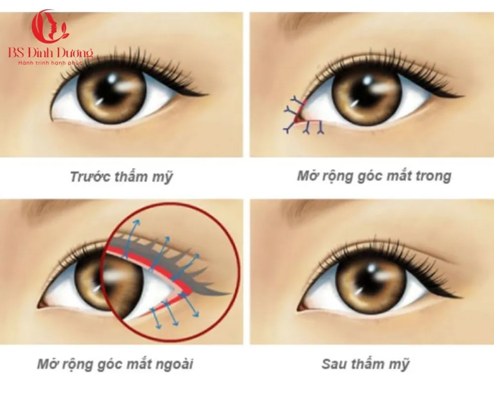 Quy Trình Mở Góc Mắt Tại Thẩm Mỹ Viện Bác Sĩ Đình Dương
