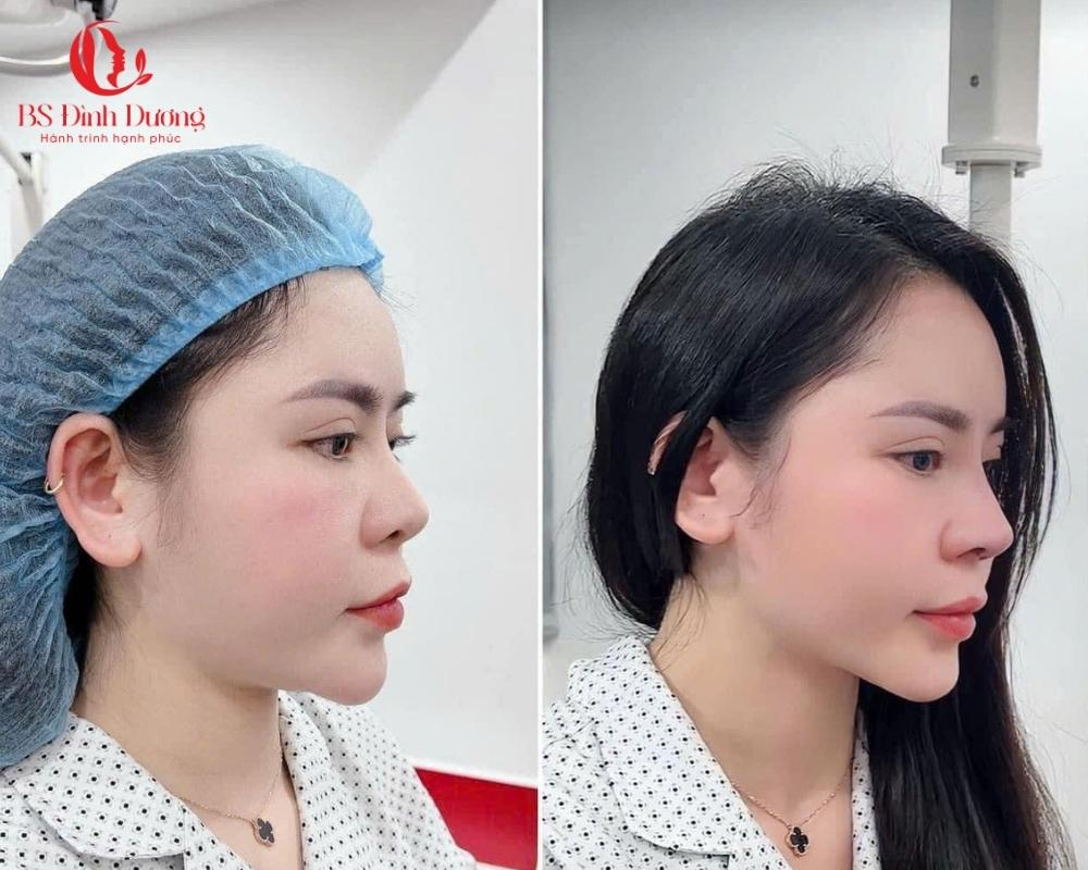 Định nghĩa nâng mũi bọc sụn – Phương pháp thẩm mỹ an toàn
