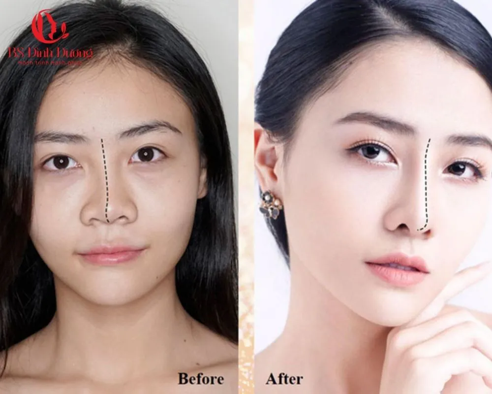 Các dấu hiệu nhận biết mũi bị biến chứng cần chỉnh sửa
