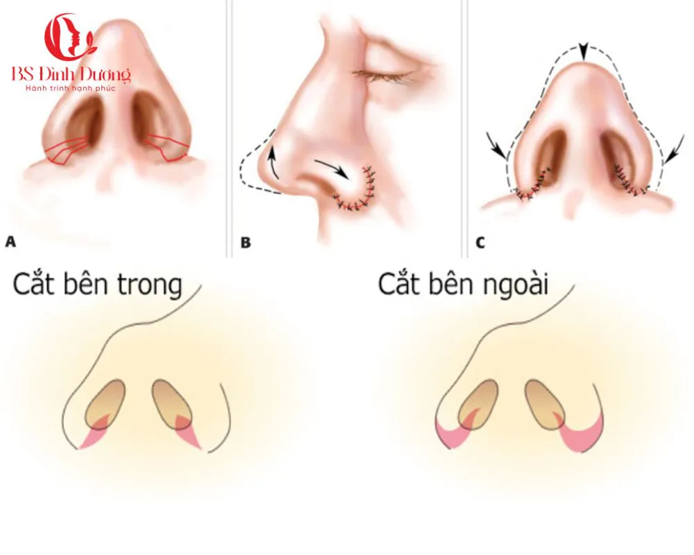 Thu gọn cánh mũi là gì? Những ai nên thực hiện