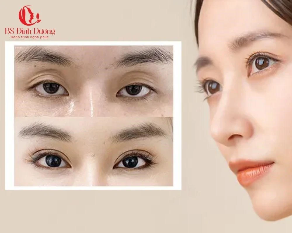 Cấy mỡ mắt có an toàn không?
