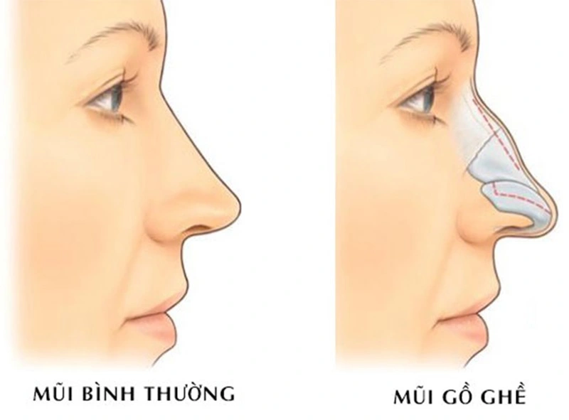 Mài gồ sống mũi – Giải pháp khắc phục sống mũi gồ, tạo dáng mũi thẳng và mềm mại