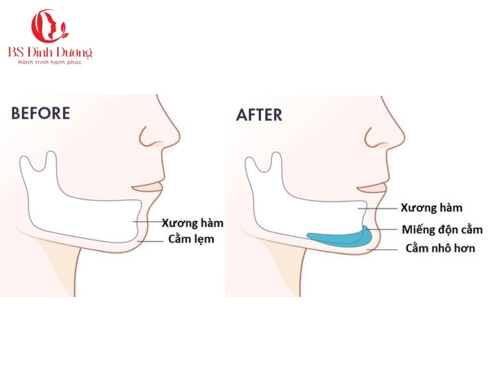 Có nên độn cằm không? Lợi ích và những điều cần biết
