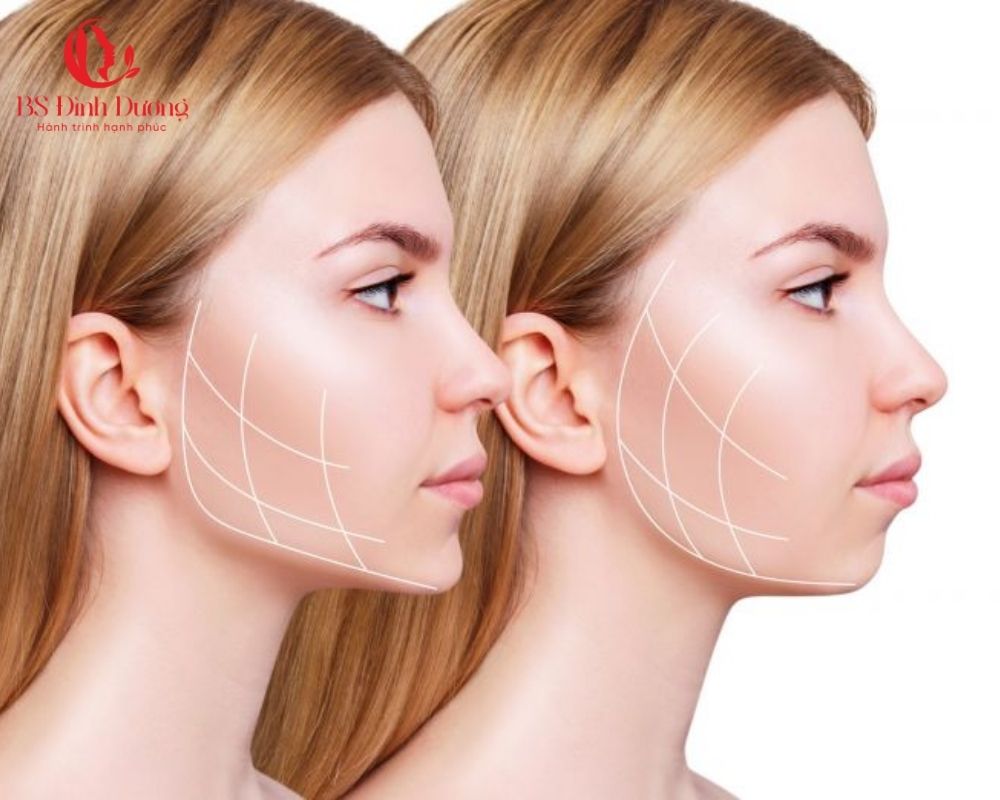 Quy Trình Độn Cằm V Line Tại Thẩm Mỹ Viện Đình Dương
