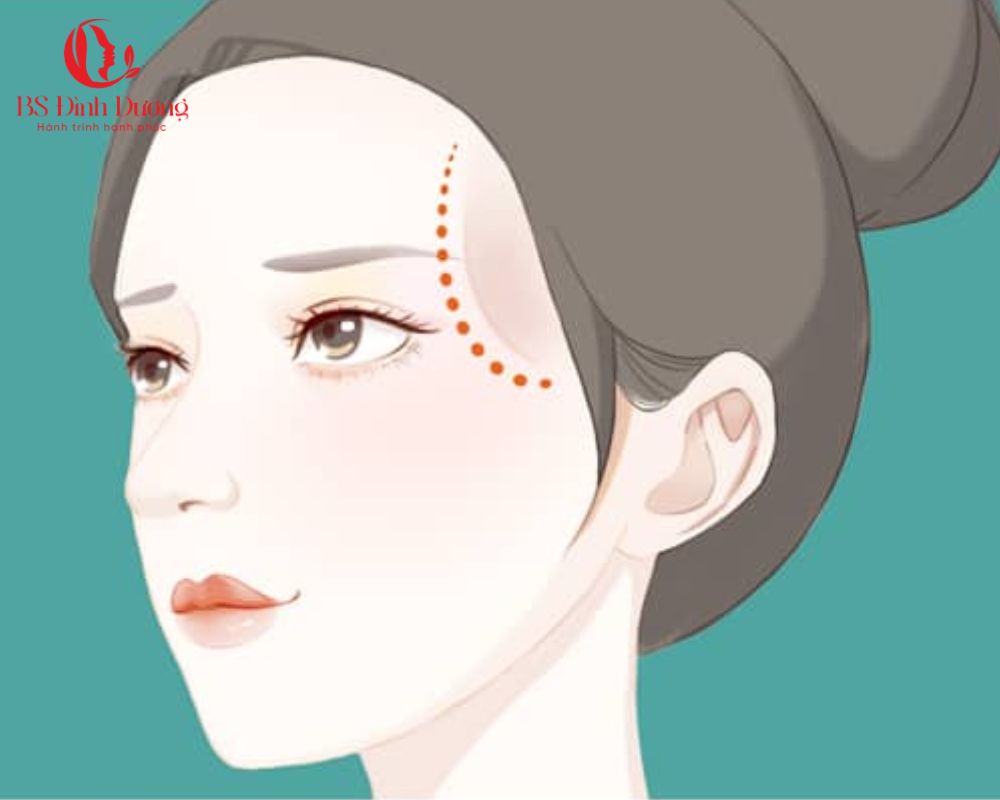Độn thái dương là gì? 
