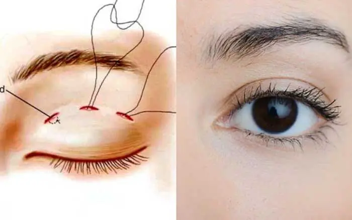Nhấn mí mắt – Phương pháp tạo mí mắt rõ nét, tự nhiên không phẫu thuật
