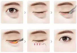 Lấy mỡ mí dưới – Giải pháp loại bỏ bọng mỡ thừ
