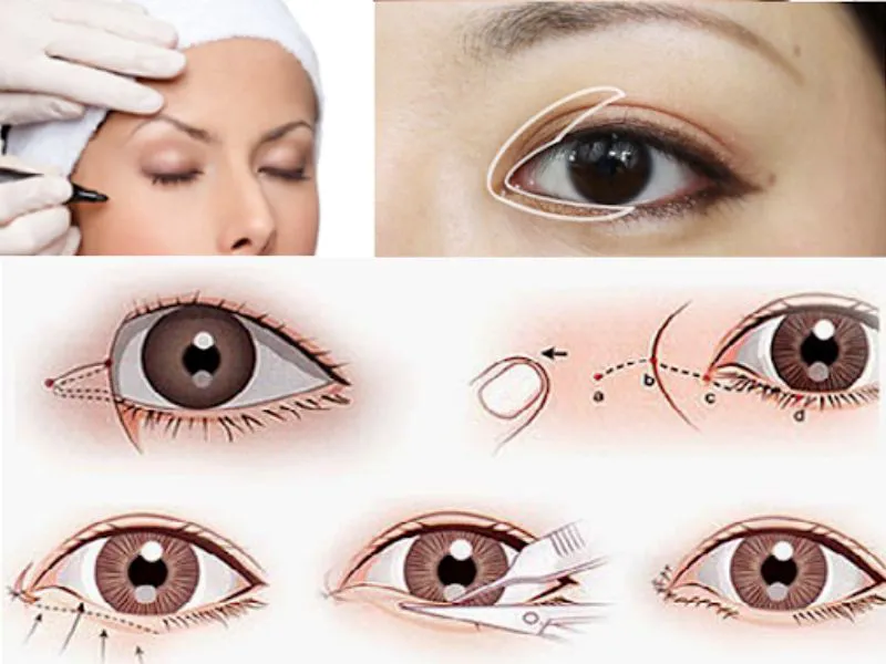 Mở góc mắt – Giúp mắt to tròn, tự nhiên và cuốn hút hơn