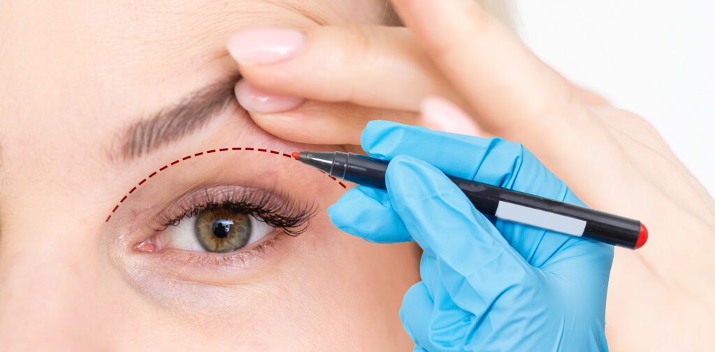 Sửa mí mắt – Giải pháp cải thiện mí mắt hỏng, giúp đôi mắt đẹp tự nhiên và rõ nét