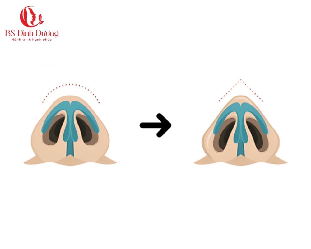 Thu gọn đầu mũi là gì?