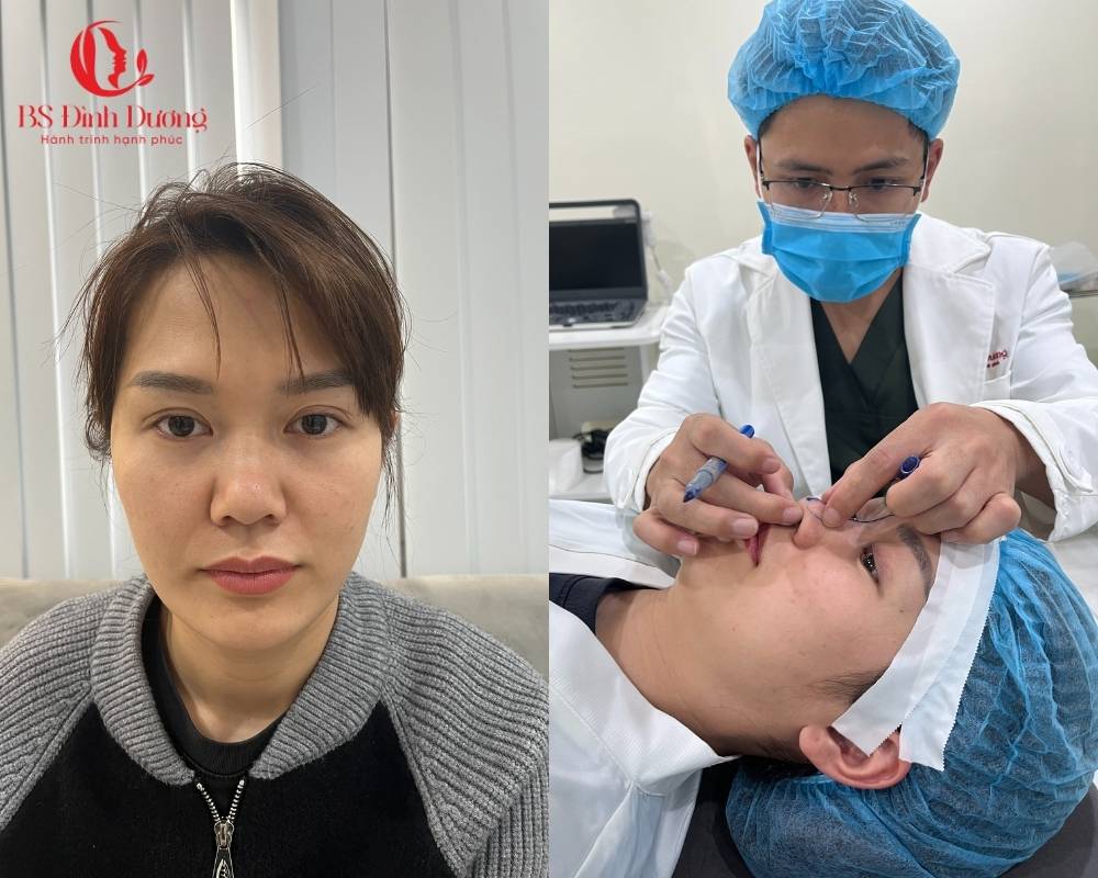 Quy Trình Phẫu Thuật Thu Gọn Đầu Mũi