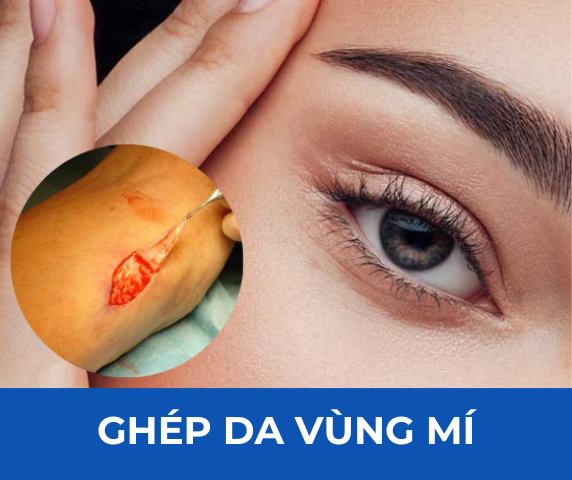 Ghép da mí dưới – Giải pháp cải thiện vùng da chùng, sạm và nhăn vùng mắt dưới