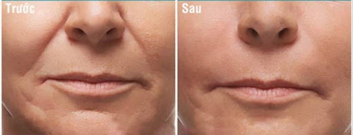 Độn rãnh mũi má – Giải pháp làm đầy, trẻ hóa khuôn mặt