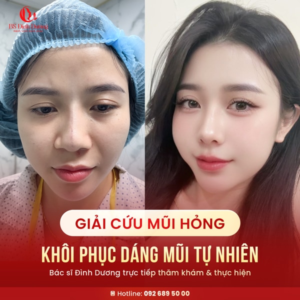 Sửa Mũi Hỏng: Giải Pháp Tái Cấu Trúc Toàn Diện Và Địa Chỉ Uy Tín Từ Bác Sĩ Đình Dương [ Cập nhật 2026 ]