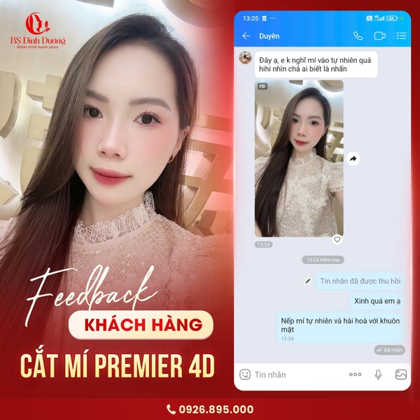 review nâng mũi bác sĩ Đình Dương sau 6 tháng
