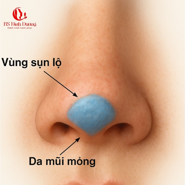 Tháo sụn mũi