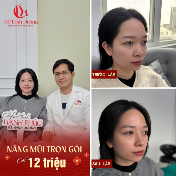 Giá nâng mũi bác sĩ Đình Dương 2026
