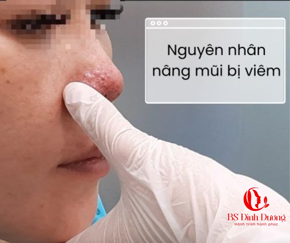 Bài viết chuyên sâu về các biến chứng nâng mũi và cách phòng tránh tình trạng sưng viêm, hướng dẫn phòng ngừa để có dáng mũi đẹp bền vững an toàn từ chuyên gia 10 năm kinh nghiệm - Bác sĩ Đình Dương.